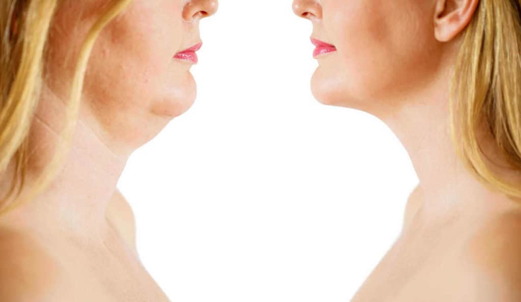 Double Chin treatment Southend-on-Sea before and after results