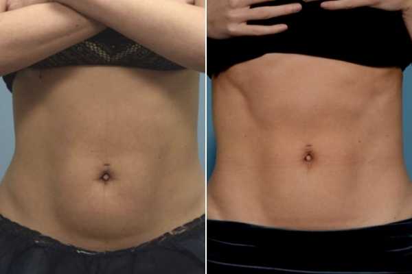 body sculpting FAQs Southend-on-Sea