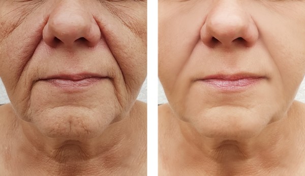 Learn more about Morpheus8 Treatment Southend-on-Sea today!