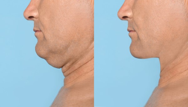 Which Non-Surgical Treatments Work Best for Jowls and Loose Skin Southend-on-Sea?