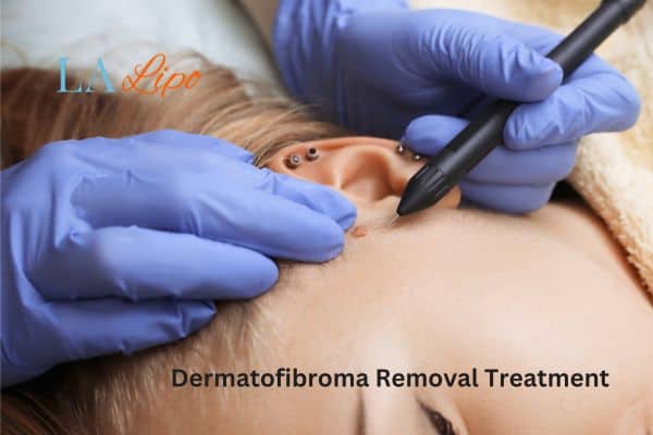Dermatofibroma Removal Treatment Southend-on-Sea