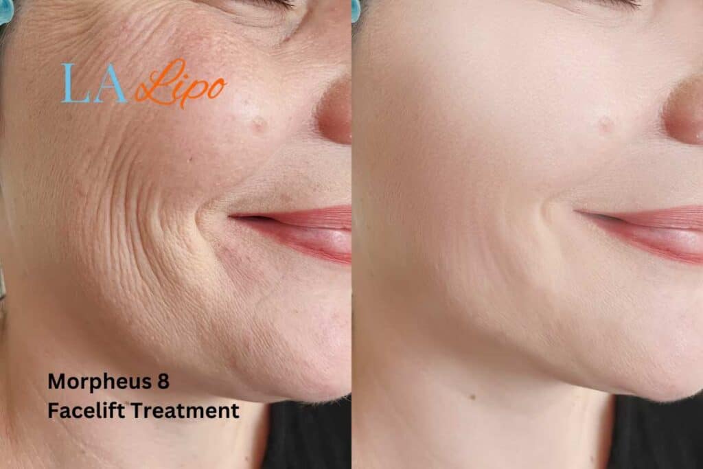 Morpheus8 Treatment Southend-on-Sea for flawless skin! Call us today!