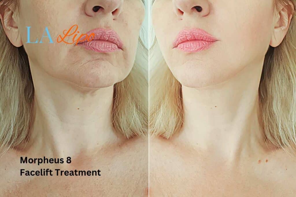 Turn back time with Morpheus8 Treatment Southend-on-Sea