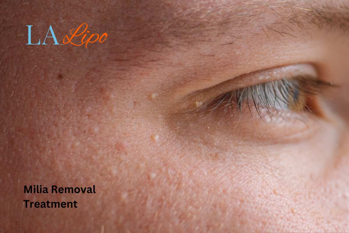 Cryopen Milia Removal: Is It the Easiest and Safest Option Southend-on-Sea?