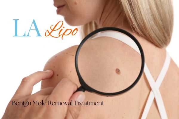 Why getting moles removed Southend-on-Sea can boost your confidence!