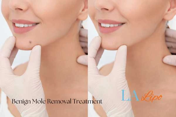 woman's before and after mole removal Southend-on-Sea results