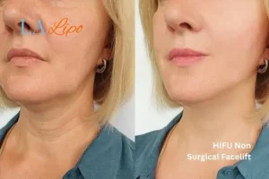 hi-fu for wrinkles Southend-on-Sea before and after results