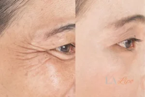 Before and after results of woman - HI-fu wrinkles reduction treatment Southend-on-Sea