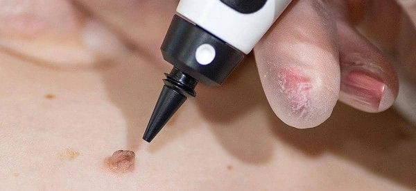 skin tag removal using cryopen Southend-on-Sea