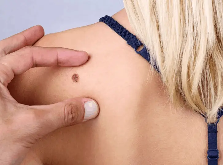 woman having mole removal Southend-on-Sea consultation before treatment.