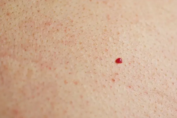 close up of a cherry angioma Southend-on-Sea