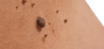 image of a skin tag Southend-on-Sea