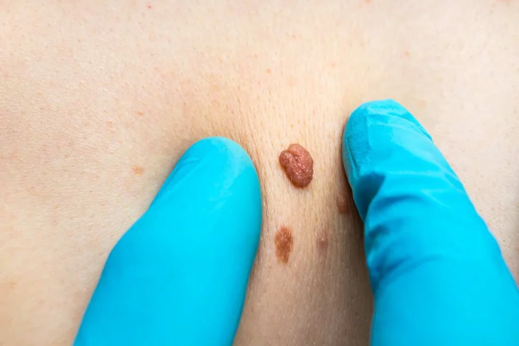 Consultant examining a skin tag Southend-on-Sea