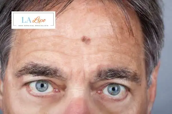 Solar Lentigo Removal Southend-on-Sea image of man with mark on his forehead