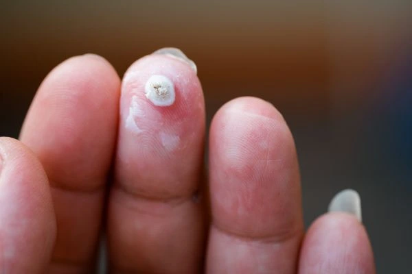 wart on person finger - cryotherapy to treat from LA LIPO Southend-on-Sea