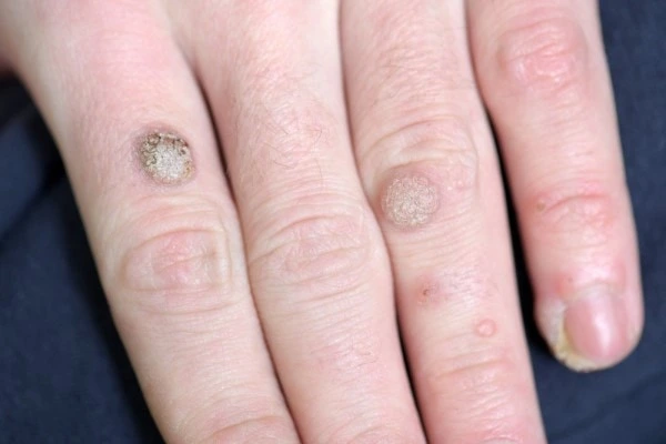photo of warts on person hand - see wart removal Southend-on-Sea from LA LIPO