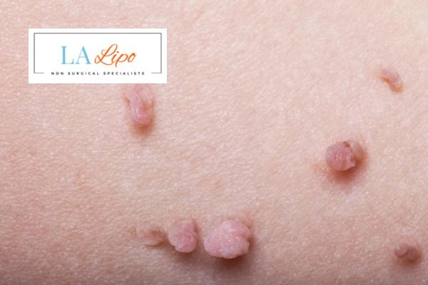 Does cryopen skin tag removal Southend-on-Sea hurt? Find out now call our team today!