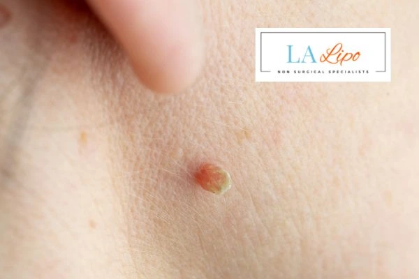 Book skin tag removal Southend-on-Sea today speak to our team now!