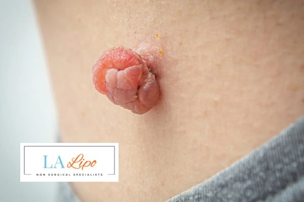 Interested in skin tag removal Southend-on-Sea? Concerned about the pain? Find out more today!