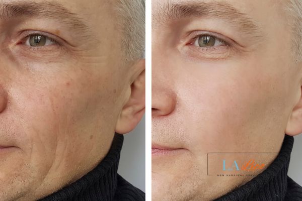 See the amazing results of Morpheus8 Treatment Southend-on-Sea!