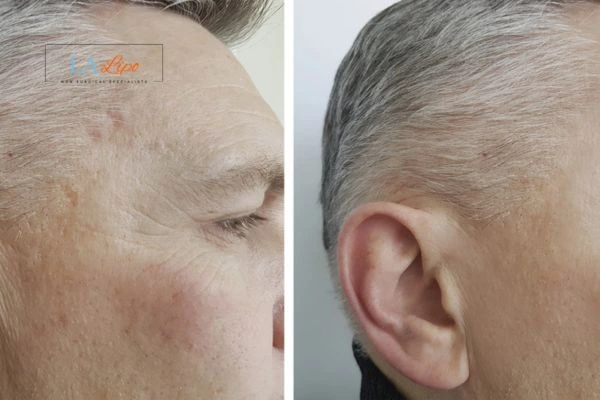 Mens Before & After Morpheus 8 Results Southend-on-Sea