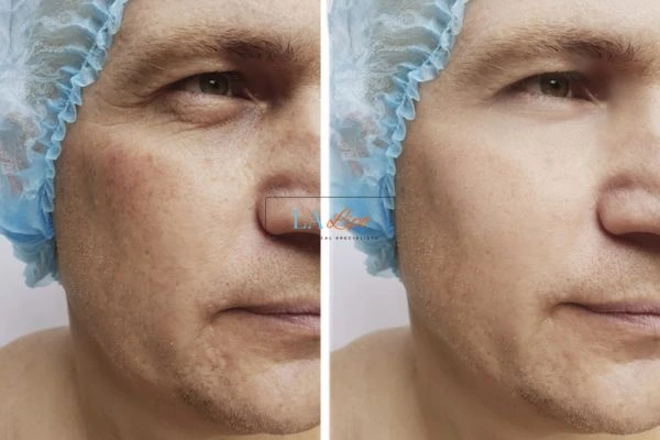 Before and after Morpheus 8 Results Southend-on-Sea