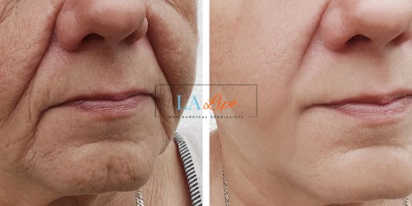 Older lady deeper wrinkle reduction - LA LIPO Morpheus 8 Results Southend-on-Sea