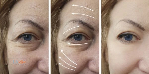 Amazing eye lift Morpheus 8 results Southend-on-Sea