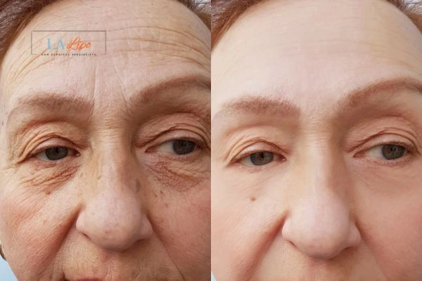 The powerful benefits of Morpheus8 Treatment Southend-on-Sea - Call Our team today!
