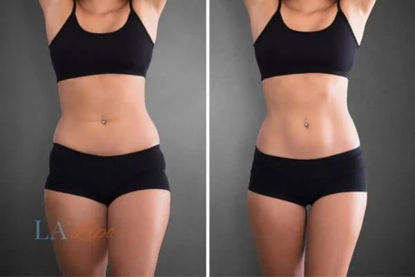 before and after results of non-surgical treatment to help a woman's body image and mental health Southend-on-Sea