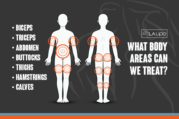 Diagram to show areas you can have LA-EMS Body Sculpting Treatment Southend-on-Sea