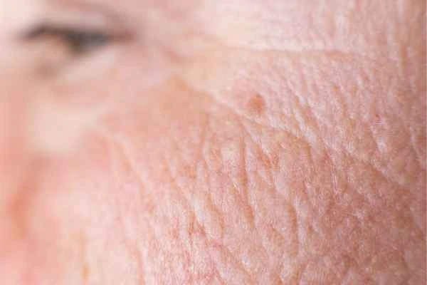 close up picture of a woman's face showing an age spot Southend-on-Sea