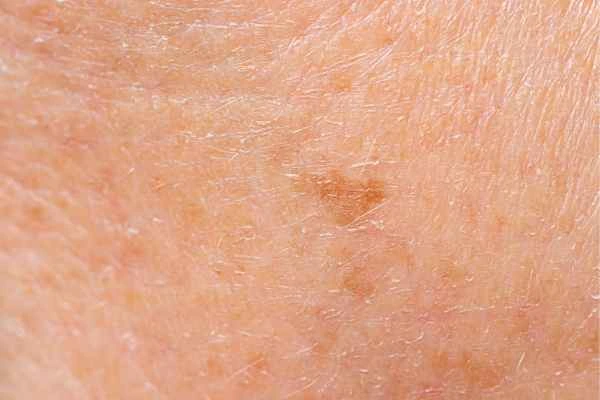 close up picture of age spots Southend-on-Sea
