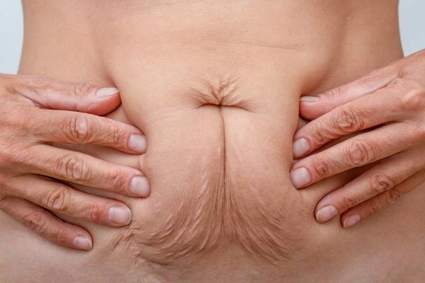Should I Combine Diastasis Recti Treatment with Body Contouring for Better Results Southend-on-Sea?