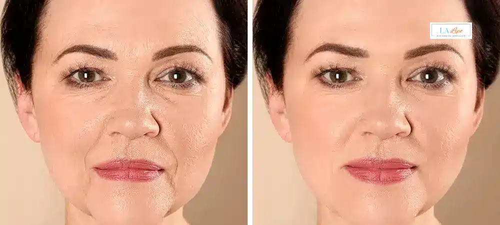 How Long Does It Take to See Results and How Long Do They Last Southend-on-Sea?