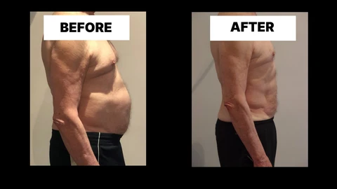What Symptoms Can Diastasis Recti Cause in Men? Weak Core, Back Pain and Poor Posture Southend-on-Sea